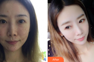 深圳美源醫(yī)療美容門診部劉金祝整形價(jià)格表附去痘印痘坑案例展示