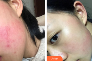 深圳同仁醫(yī)療美容醫(yī)院姜昱瑾整形價(jià)格表附皮膚管理案例展示