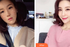 深圳同仁醫(yī)療美容醫(yī)院李斌—整形價(jià)格表附清潔祛痘案例展示