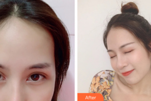 深圳博愛醫(yī)院整形美容中心白云整形價(jià)格表附眼部手術(shù)案例展示