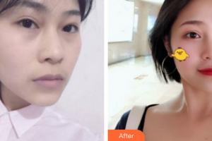 深圳博愛醫(yī)院整形美容中心賀海風(fēng)整形價(jià)格表附埋線提升案例展示