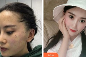 寧波協(xié)和儷人醫(yī)療美容門診部張慧整形價(jià)格表附面部提升案例展示