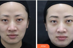 寧波壬美醫(yī)療美容醫(yī)院杜康軍整形價(jià)格表附眼部綜合案例展示