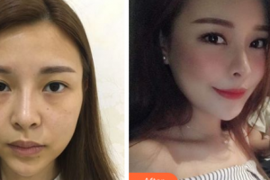 懷化天姿整形美容醫(yī)院吳載源整形價格表附自體脂肪全臉填充案例展示