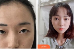 寧波江北口腔醫(yī)院黃觀華整形價(jià)格表附切開(kāi)雙眼皮案例展示