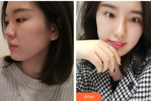 寧波尚麗整形美容醫(yī)院喻正虹整形價(jià)格表附眼部綜合案例展示