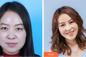 寧波尚麗整形美容醫(yī)院金弘烈整形價(jià)格表附膨體隆鼻案例展示