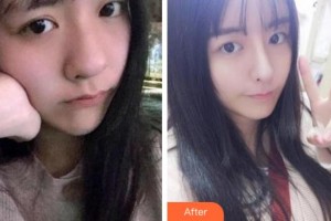 寧波協(xié)和儷人醫(yī)療美容門診部帥霞整形價(jià)格表附熱瑪吉案例展示