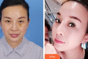 寧波美萊整形美容醫(yī)院張瑋整形價(jià)格表附埋線提升案例展示