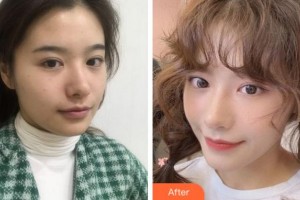 寧波美萊整形美容醫(yī)院李洋整形價(jià)格表附熱瑪吉案例展示