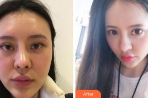 寧波美苑醫(yī)療美容醫(yī)院馬肖琳整形價(jià)格表附埋線提升案例展示