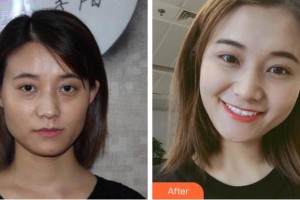 寧波孫敏醫(yī)療美容診所孫敏整形價(jià)格表附埋線提升案例展示