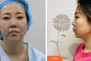 寧波大學(xué)醫(yī)學(xué)院附屬醫(yī)院整形外科任森洋整形價(jià)格表附埋線提升案例展示