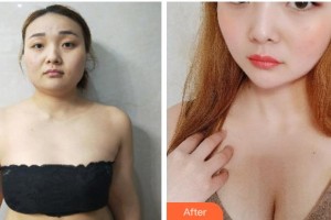 寧波壬美醫(yī)療美容醫(yī)院徐楠整形價(jià)格表附自體脂肪隆胸案例展示