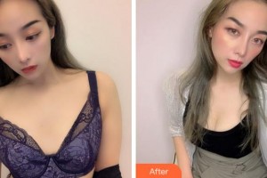 寧波珈禾整形?？漆t(yī)院陳樂(lè)琴整形價(jià)格表附自體脂肪隆胸案例展示