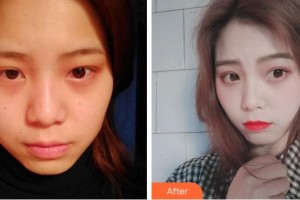 寧波徐建國(guó)美容整形醫(yī)院吳忠孝整形價(jià)格表附激光祛斑案例展示