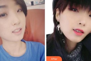 寧波珈禾整形?？漆t(yī)院鮑琴兒整形價(jià)格表附金屬托槽矯正案例展示