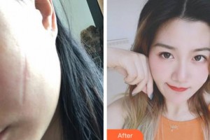 寧波市李惠利醫(yī)院燒傷整形外科金麗華整形價(jià)格表附手術(shù)祛疤案例展示