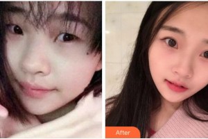 寧波美仁整形美容醫(yī)院潘杰整形價格表附切開雙眼皮案例展示