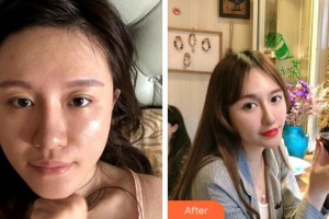 寧波協(xié)和儷人醫(yī)療美容門診部李曉霞整形價格表附埋線提升案例展示