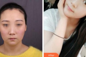 寧波陳標(biāo)新整形美容醫(yī)院權(quán)鏞頊整形價格表附埋線提升案例展示