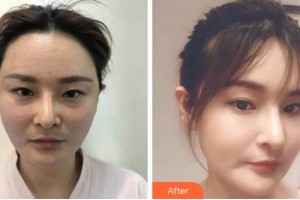 寧波美仁整形美容醫(yī)院柳杬敏整形價格表附埋線提升案例展示