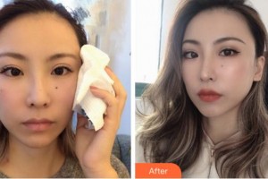 寧波薇琳醫(yī)療美容門診部徐廷五整形價格表附埋線提升案例展示