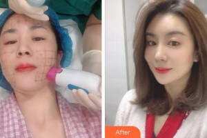 寧波薇琳醫(yī)療美容門診部盧仁鎬整形價格表附熱瑪吉案例展示