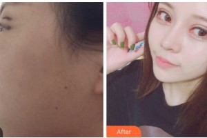 寧波徐建國美容整形醫(yī)院徐建國整形價格表附眼部綜合案例展示