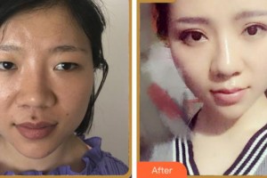 寧波雅韓醫(yī)療美容醫(yī)院劉成林整形價格表附眼部綜合案例展示