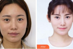 寧波米陽整形門診部羅遠(yuǎn)洪整形價格表附眼部綜合案例展示