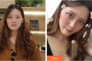 寧波尚美整形美容醫(yī)院齊強整形價格表附切開雙眼皮案例展示