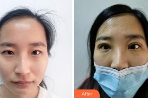 寧波明州醫(yī)院整形美容中心王秉彥整形價格表附眼部綜合案例展示