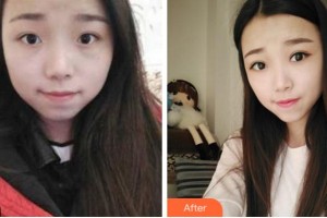 寧波明州醫(yī)院整形美容中心周惠能整形價格表附切開雙眼皮案例展示