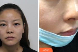 寧波復大皮膚病?？漆t(yī)院徐暉整形價格表附隆鼻案例展示