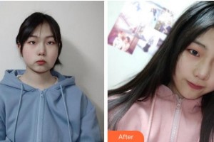 寧波復大皮膚病?？漆t(yī)院武文帥整形價格表附埋線提升案例展示