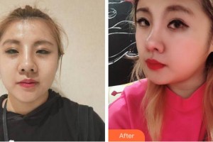 寧波復大皮膚病?？漆t(yī)院王安平整形價格表附熱瑪吉案例展示