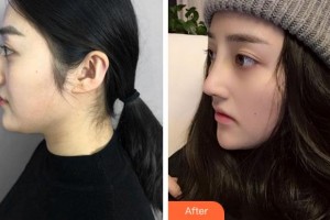 寧波韓美醫(yī)療美容門診部張建波整形價格表附鼻部綜合案例展示