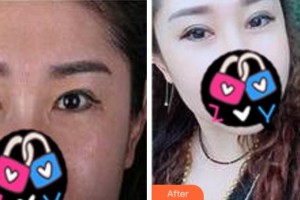 寧波韓美醫(yī)療美容門診部黃艷紅整形價格表附眼部修復案例展示