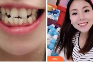 寧波江北口腔醫(yī)院李幼華整形價格表附金屬托槽矯正案例展示