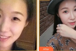 寧波美塑醫(yī)療美容門診部王學軍整形價格表附熱瑪吉案例展示