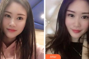 寧波市第六醫(yī)院整形外科胡瑞斌整形價格表附冷光美白案例展示