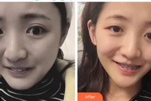 寧波拜博拜爾口腔醫(yī)院吳學銘整形價格表附金屬托槽矯正案例展示