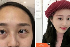 寧波鄞州眼科醫(yī)院周宏健整形價格表附內(nèi)切祛眼袋案例展示