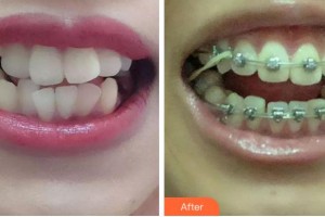 寧波拜博拜爾口腔醫(yī)院潘秋靜整形價格表附牙齒矯正案例展示