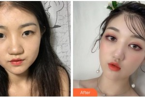 寧波鄞州眼科醫(yī)院周開晶整形價格表附眼部綜合案例展示