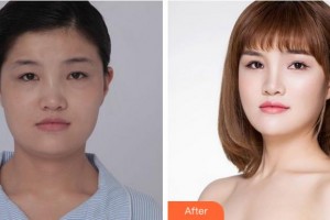 寧波市北侖區(qū)人民醫(yī)院眼科劉嵐整形價格表附眼部綜合案例展示