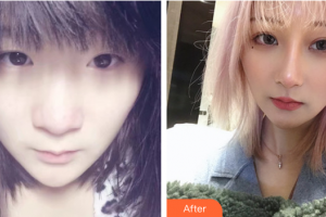 深圳麗港麗格醫(yī)療美容門診部謝俊整形價(jià)格表附隆鼻案例展示