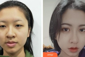 寧波市北侖區(qū)人民醫(yī)院眼科盛艷整形價格表附眼部綜合案例展示