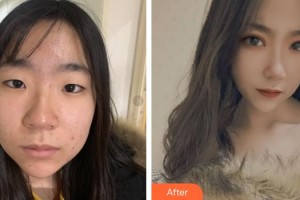 寧波愛爾光明眼科醫(yī)院高小明整形價格表附埋線雙眼皮案例展示